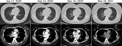 Case Report: Identification of Two Rare Fusions, PDK1-ALK and STRN-ALK, That Coexist in a Lung Adenocarcinoma Patient and the Response to Alectinib